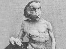 Sindrome di Proteo: l'uomo che cresce sempre - 2 Joseph Merrick