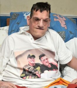 Sindrome di Proteo: l'uomo che cresce sempre - 3 Robert Smith Sindrome di Proteo